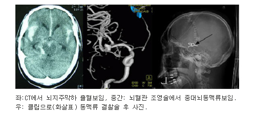 좌측사진:CT에서 뇌지주막하 출혈보임, 중간사진:뇌혈관 조영술에서 중대뇌동먁류보임, 우측사진 : 클립으로 결찰술 후 사진