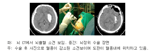 좌측사진 : 뇌 CT에서 뇌출혈 소견 보임, 중간사진 : 뇌정위 수술 장면, 우측사진 : 수술 후 사진으로 혈종이 감소된 소견보이며 도관이 혈종내에 위치하고 있음