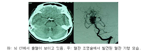 좌측사진 : 뇌 CT에서 출혈이 보이고 있음, 우측사진 : 혈관 조용술에서 발견된 혈관 기형 모습