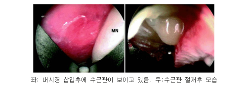 좌측사진 : 내시경 삽입후에 수근관이 보이고 있음, 우측사진 : 수근관 절개후 모습.