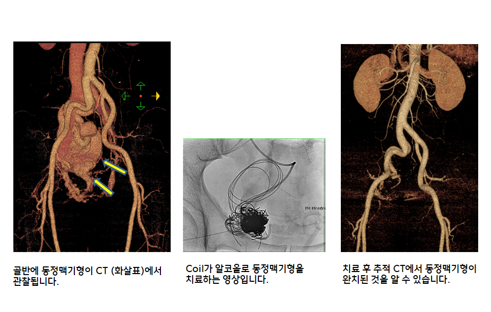 )ݿ Ʊ CT (ȭǥ) ˴ϴ. ߾)Coil ڿ÷ Ʊ ġϴ Դϴ. )ġ   CT Ʊ ġ    ֽϴ.